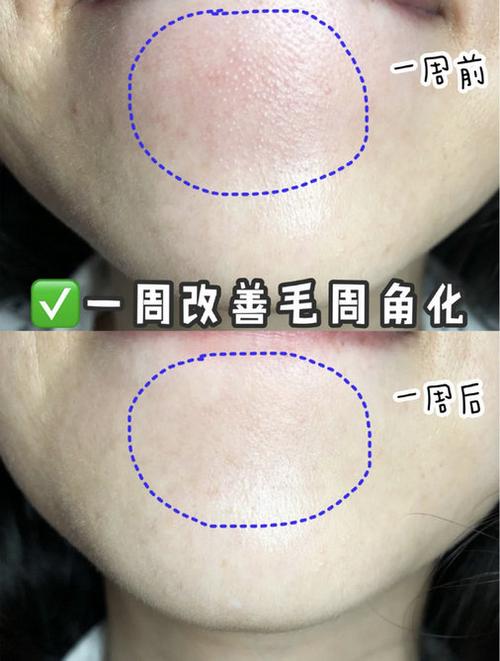 pmpm水杨酸棉片好用吗怎么使用敷多久实测改善毛周角使用效果