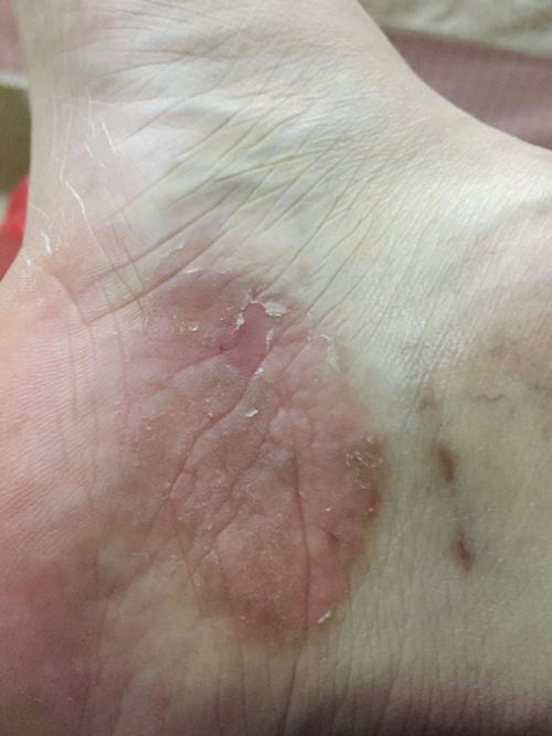 脚踝内部这个皮肤问题是什么东东啊