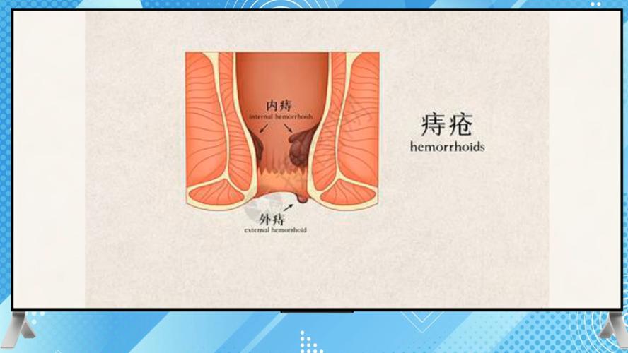 痔疮最佳的自愈方法