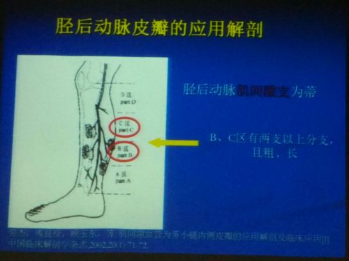 胫后动脉营养的穿支皮瓣——华山经验