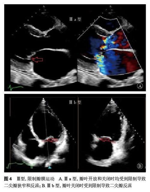 2经胸二维超声心动图