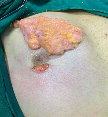 最后将患者异常发育的腺体通过小小的切口取出,结束手术.