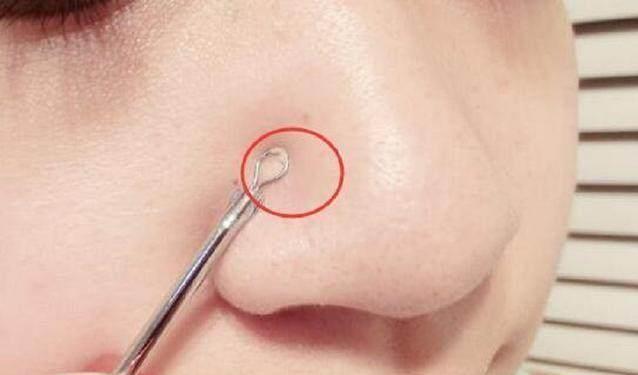 鼻子上挤出来的"小白点"是黑头还是螨虫?这样能轻松辨别!