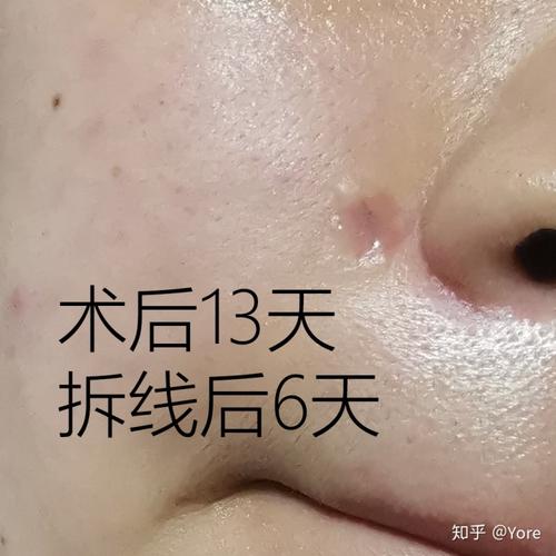 拆线6天,自己图的祛疤膏