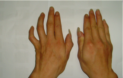 神经炎早期和晚期-神经炎症状-复禾健康