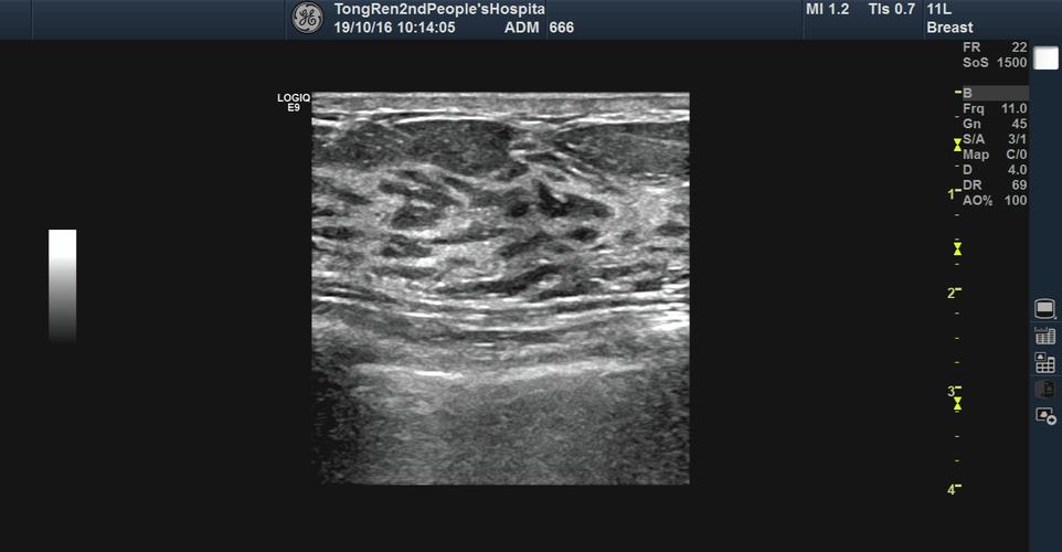 乳腺增生超声检查的临床意义