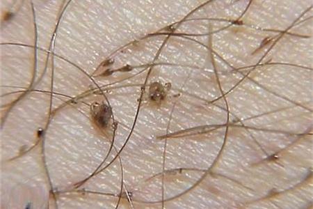 【孕妇得了阴虱怎么办】孕妇长阴虱怎么办_孕妇阴虱怎么治疗_亲亲宝贝