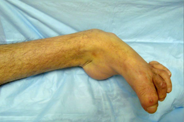 宝宝马蹄内翻足畸形复发怎么办?