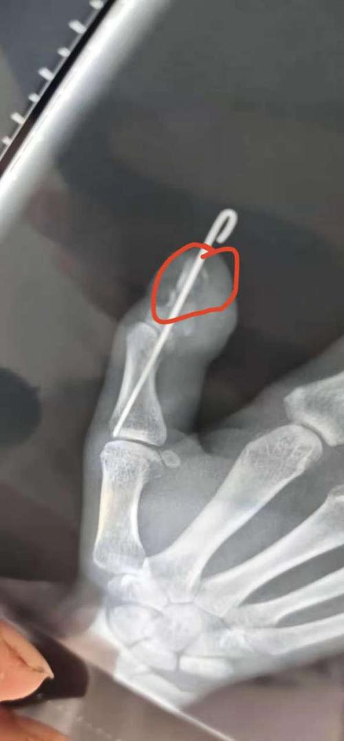 梁平邹总:拇指骨里打钢针