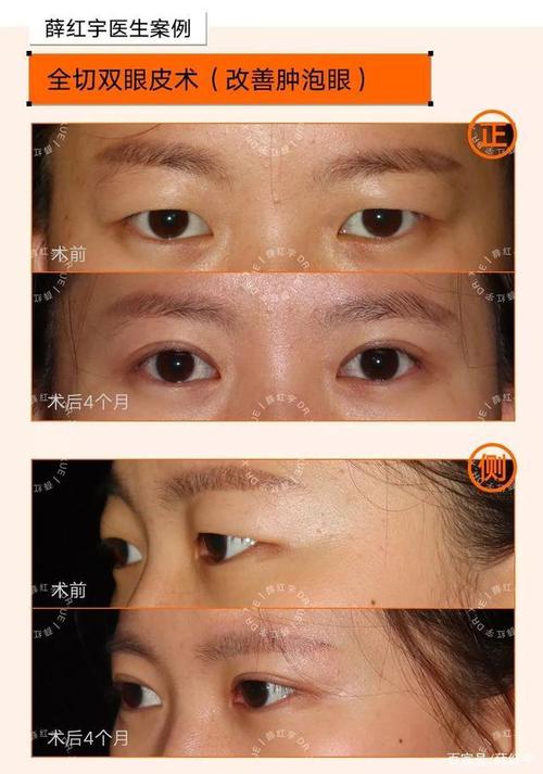 眶隔脂肪|眼袋|双眼皮|松垂