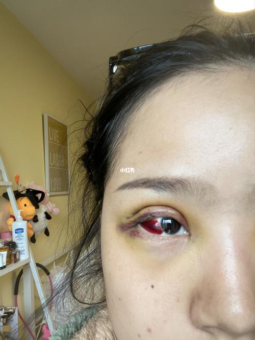 眼综合后眼睛充血严重是怎么回事怎么办_眼综合_美妆