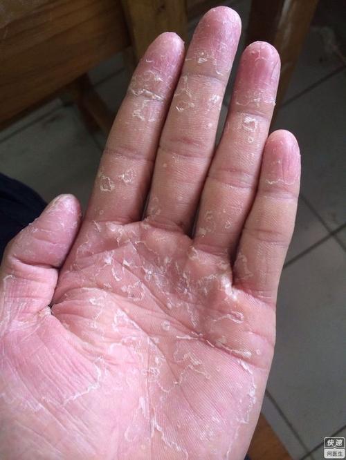 鹅掌风就是俗称的手癣.不易控制.分水泡鳞屑性和角化增厚型两种.