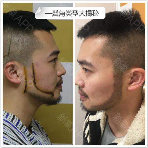 鬓角种植类型大揭秘?看你喜欢哪一种