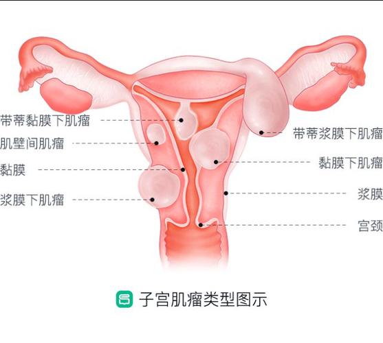 下腹部包块腹痛当心子宫表面长了东西别怕这种情况才用看医生