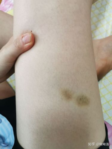 这是小腿 感觉找到组织了 没有碰没有磕  莫名其妙淤青还好不了()不