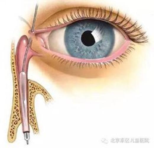 手术治疗措施:若不能自行痊愈或治疗无效,半岁以后可考虑行泪道探通术