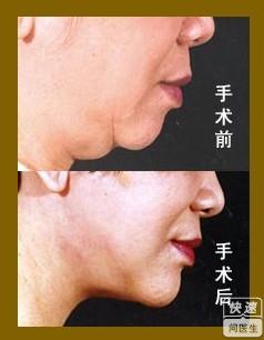 超声吸脂去掉双下巴