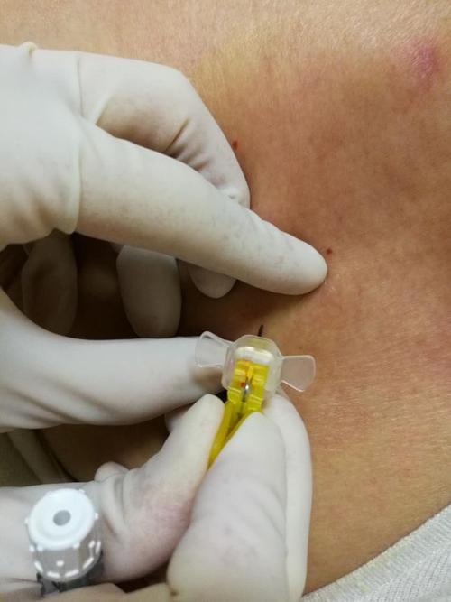 输液港如何穿刺和固定一起找找被你忽略的问题