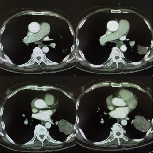 左肺下叶巨大软组织肿块 肺癌?