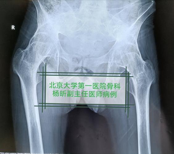 强直性脊柱炎髋关节强直怎么办?