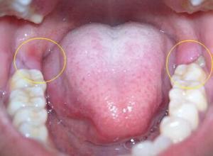 拔牙后发炎的症状是什么拔牙后发炎怎么办