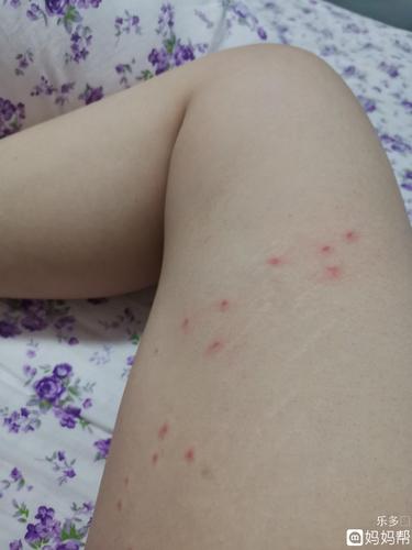 腿内侧长了一片一片的小红点