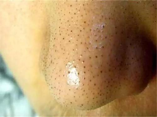 黑头里面住了成千上万的螨虫做对这四件事连虫卵都能消灭