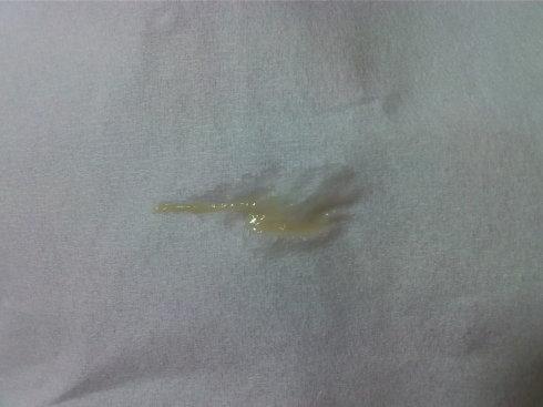 而第一张图这坨白带看起来颜色好像是碘液,白带和那时出的血   下面