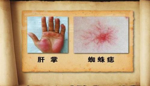 摇滚歌手臧天朔因肝癌凌晨去世,关于肝癌,这些信号一定要了解!