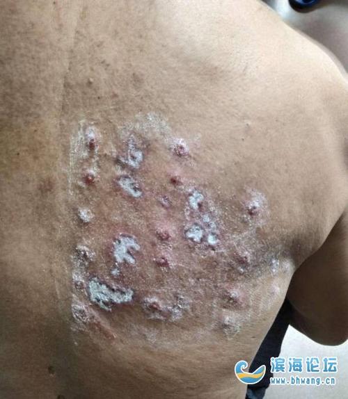 老爸后背长蛇胆疮了,疼得不得了,有什么办法吗?