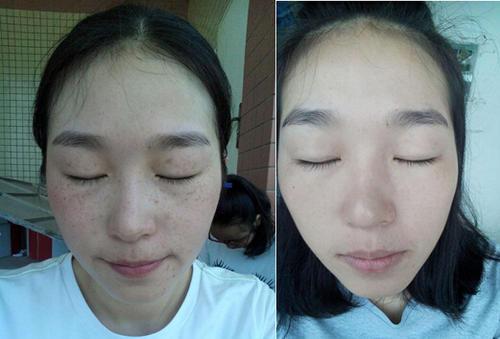 超皮秒祛斑这样祛斑才算是干净的嘛