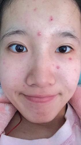 有天醒来发现水痘里面的液体开始变浑浊,整个水痘也开始变干,先起的