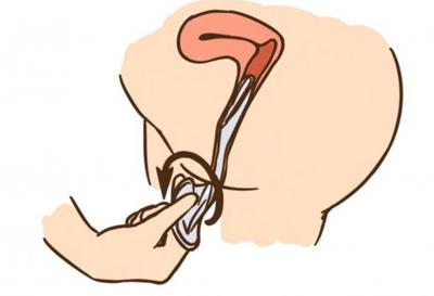 详解女式避孕套使用方法(组图)