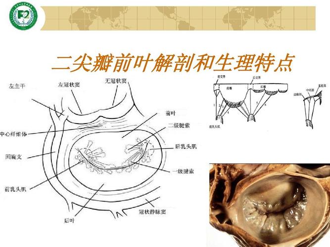 多种二尖瓣成形技术治疗二尖瓣前叶关闭不全ppt
