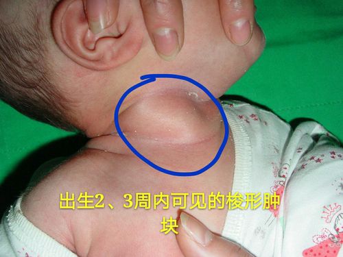 宝宝脖子歪了是怎么回事?