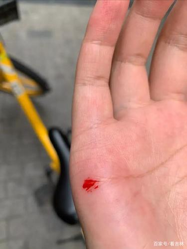 手被扎流血.