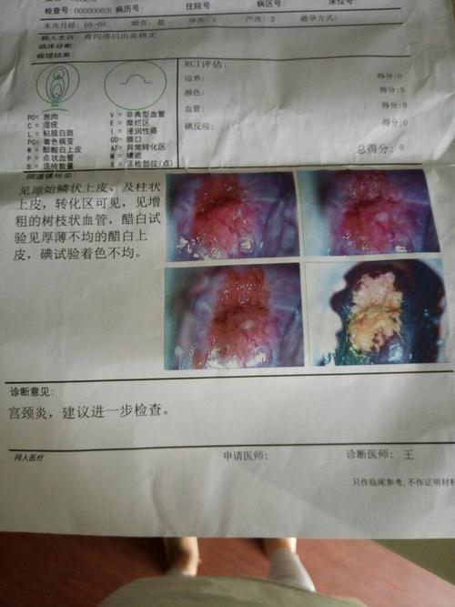 宫颈糜烂两度,同房后会出血,要用什么药治疗?