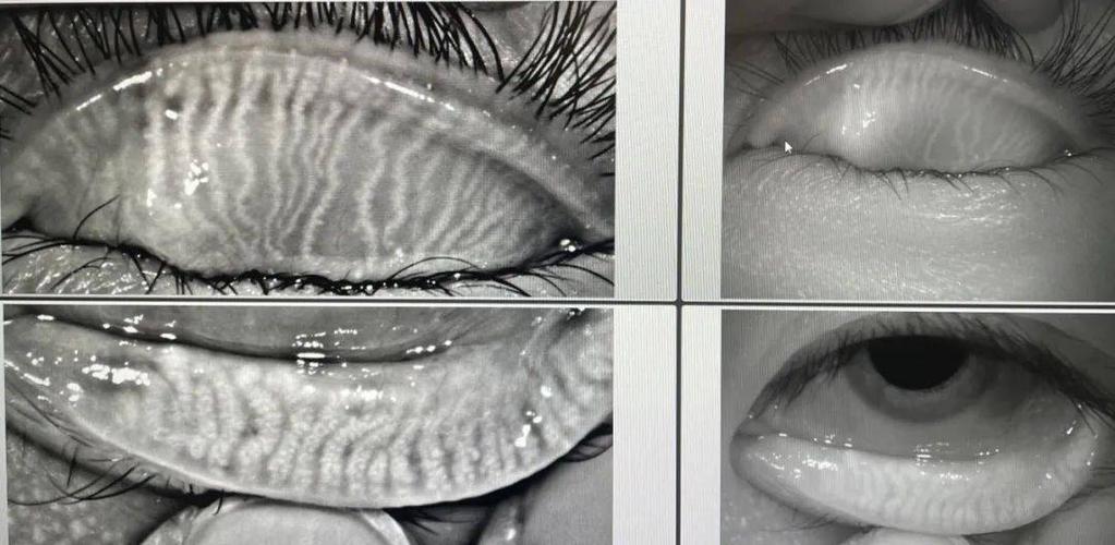 带您了解"睑板腺"?