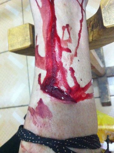 伤口感染几天好