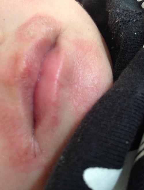 宝宝嘴唇干裂多喝水也没用怎么办看看老中医的正确护理方法