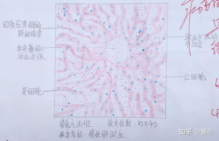 仅供参考 慢性肝淤血 ,急性蜂窝组织性阑尾炎(肌层),皮肤高分化鳞癌
