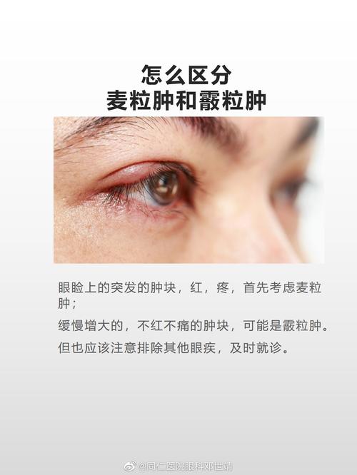 麦粒肿和霰粒肿到底怎么不一样咱们从病因开始分析