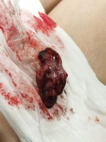 胚胎应该拿去化验了吖,这个一大块是什么吖?