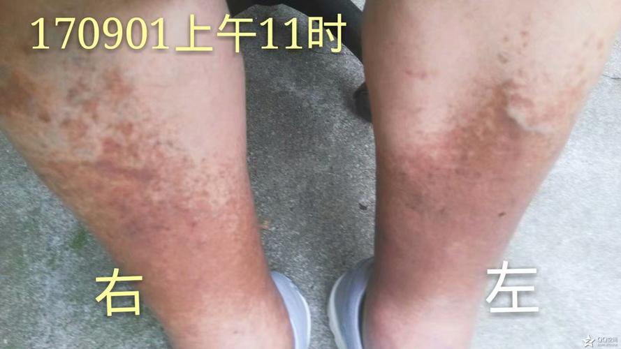 我现在因为糖尿病的并发症引起小腿下半段黑色素沉积,皮肤发黑,应该