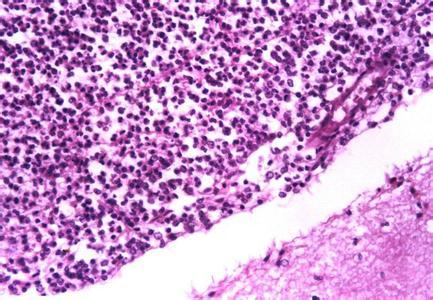 化脓性脑膜炎的症状 如何治疗化脓性脑膜炎