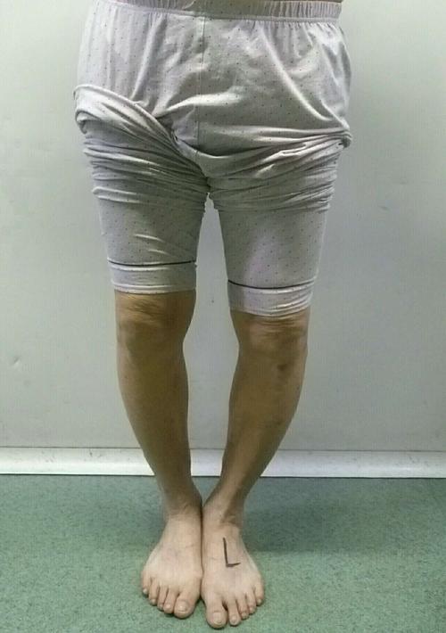 膝内翻(o型腿)的治疗