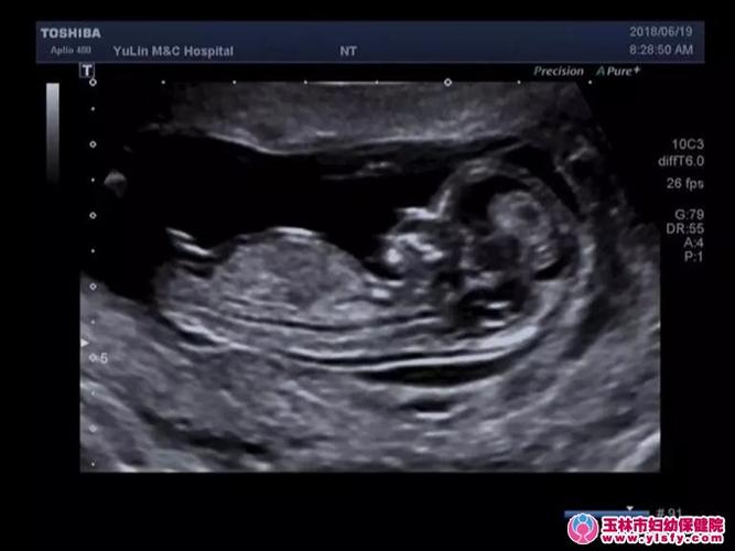 nt筛查标准切面图