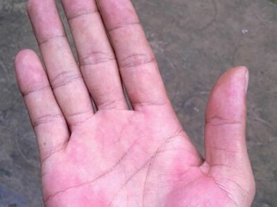 手出现这些症状可能是肝掌