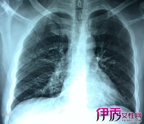 肺气肿会变成肺癌吗 肺气肿患者的寿命