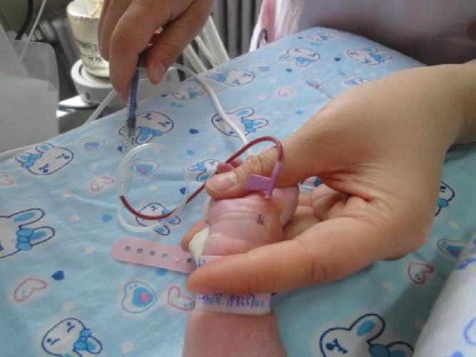 新生儿桡动脉穿刺技巧